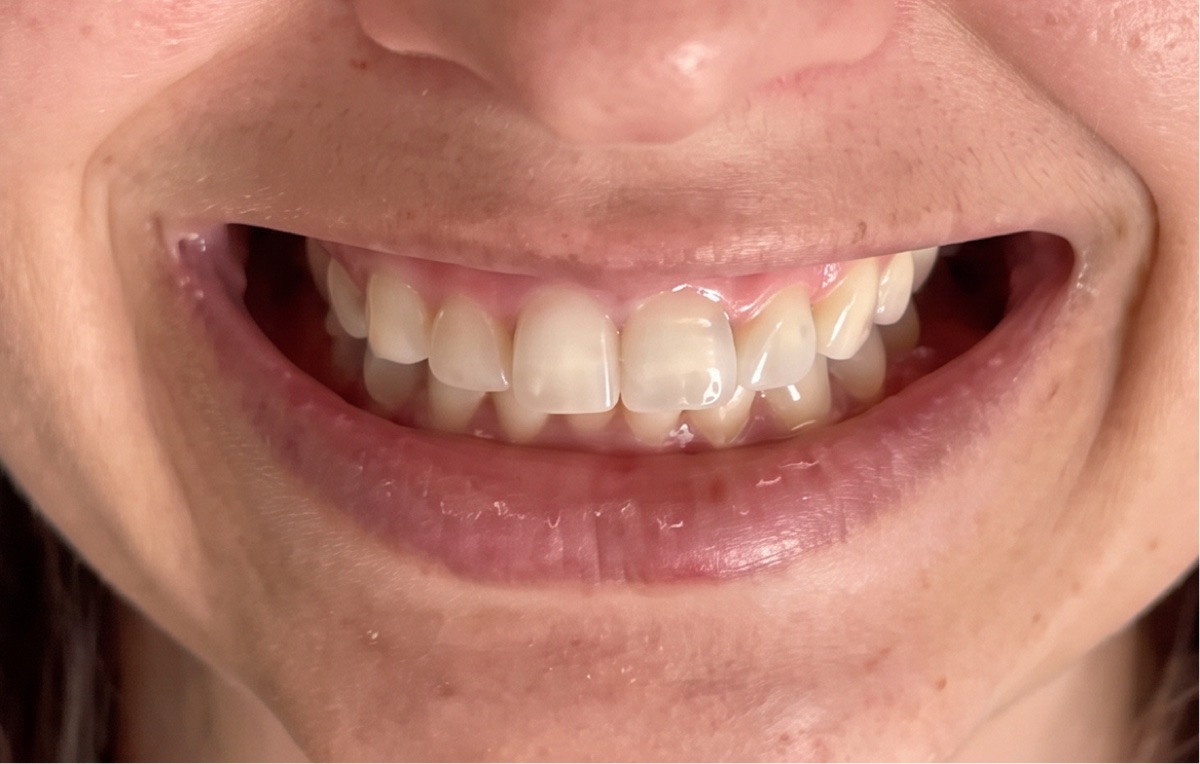 Exemplo: Sorriso natural